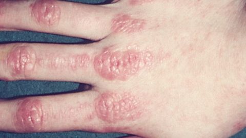 Un ni&ntilde;o que padece dermatomiositis juvenil