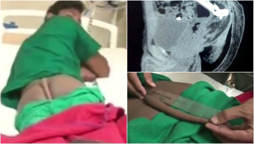 Amputan a un joven una cola de coxis de 18 centímetros que le provocaba fuertes dolores Amputan a un joven una cola de coxis de 18 centímetros que le provocaba fuertes dolores