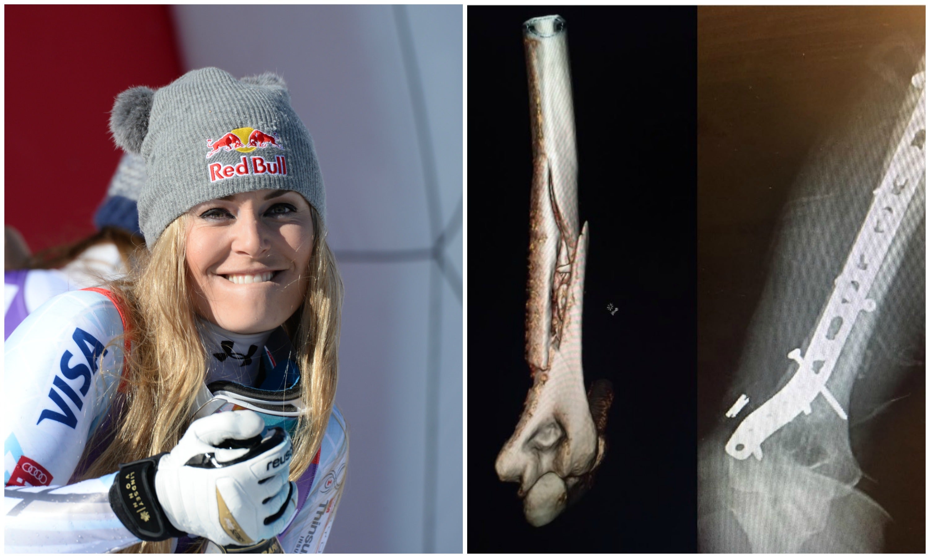 La espeluznante cicatriz de Lindsey Vonn tras fracturarse el húmero La espeluznante cicatriz de Lindsey Vonn tras fracturarse el húmero