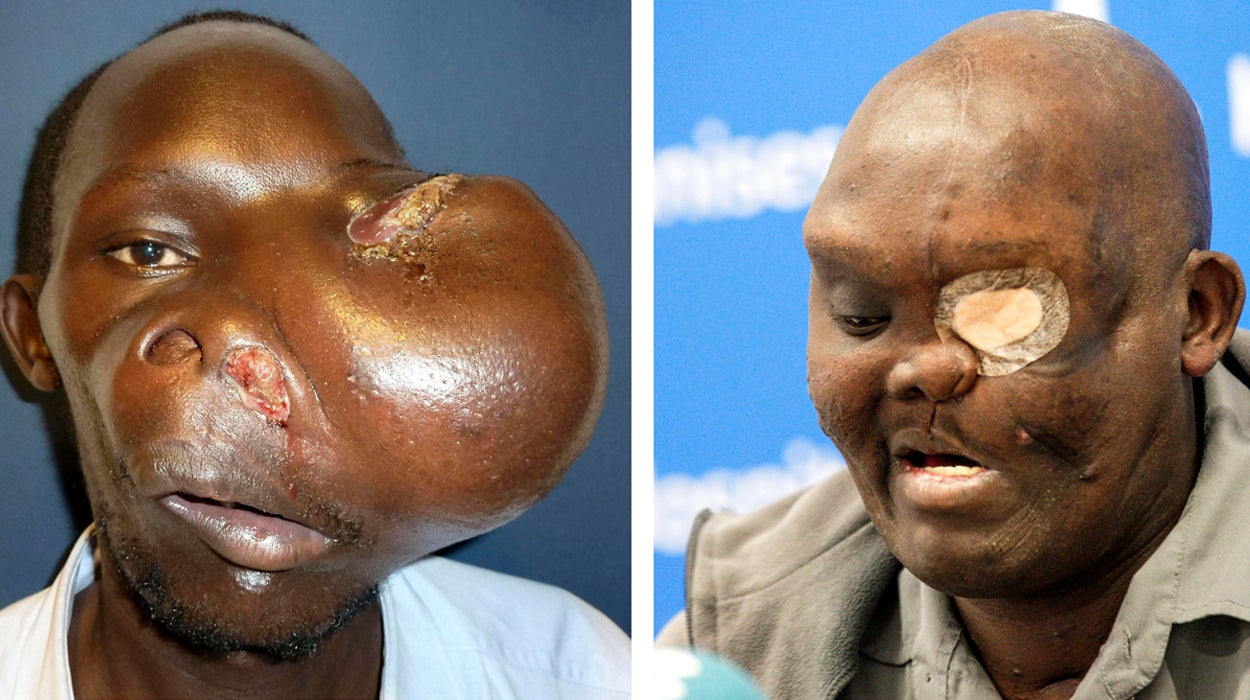 El doctor Cavadas opera 4 veces a un keniata afectado por un tumor gigante El doctor Cavadas opera 4 veces a un keniata afectado por un tumor gigante