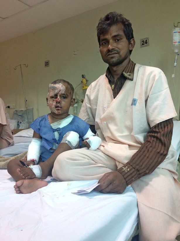 Un niño de dos años sufre quemaduras en la cara después de que el novio de su madre le arrojara ácido Un niño de dos años sufre quemaduras en la cara después de que el novio de su madre le arrojara ácido