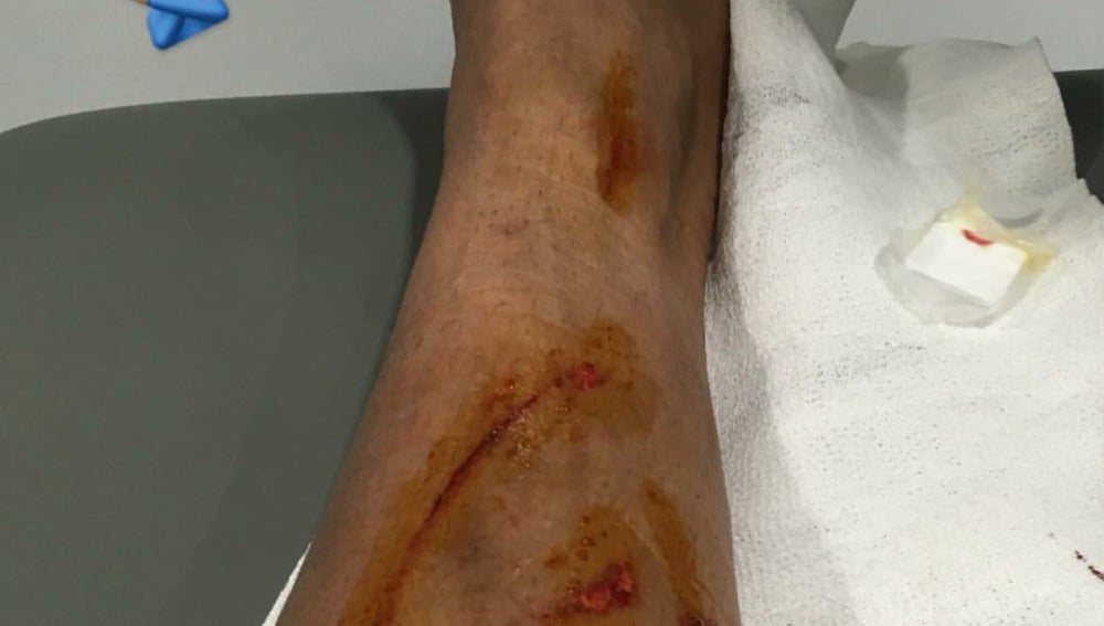 La pierna de Danilo tras el choque con David García