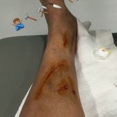La pierna de Danilo tras el choque con David García