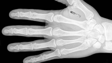 Implantaci&oacute;n de chip bajo la piel