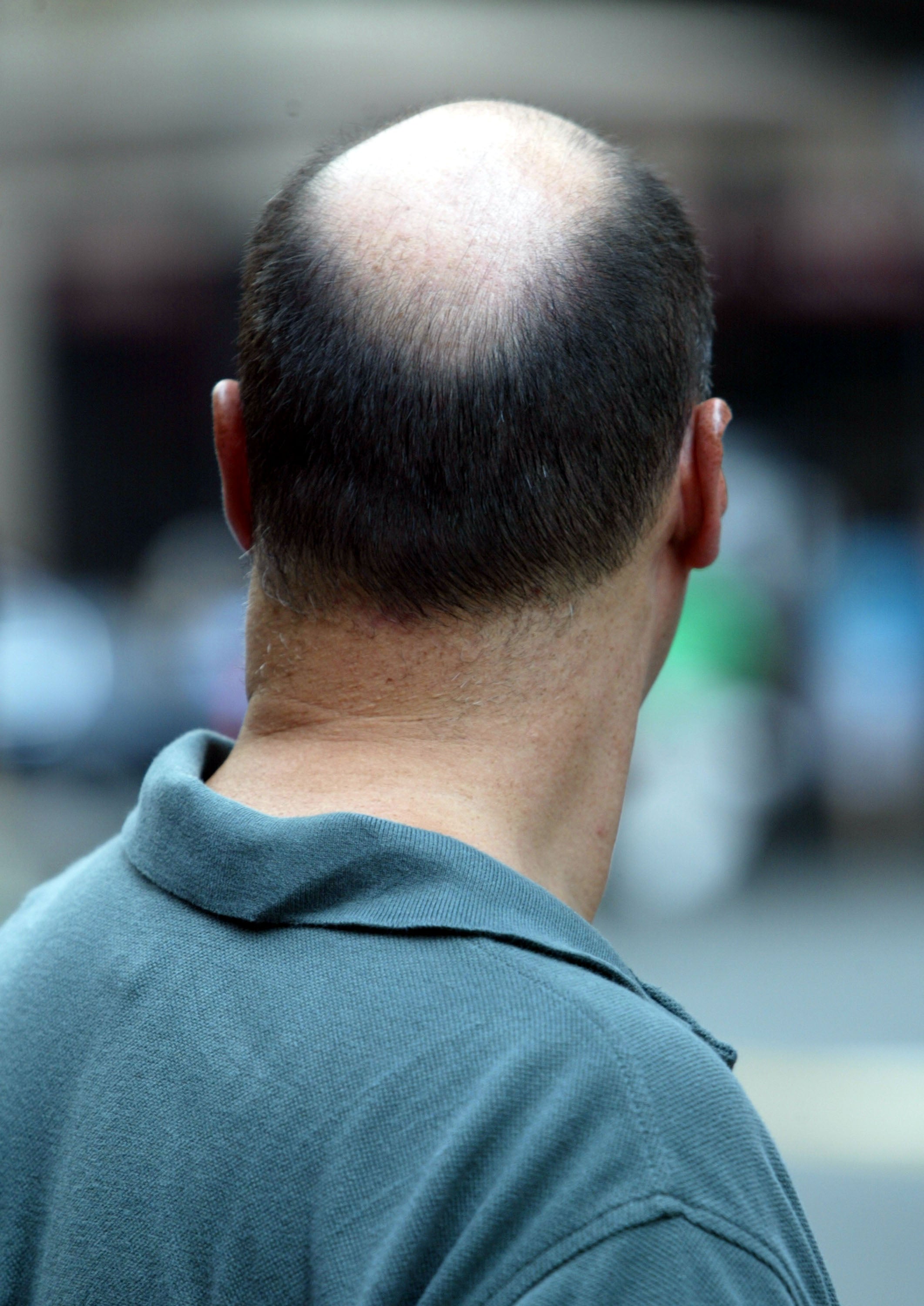 Un tribunal dictamina en Reino Unido que llamar 'calvo' a un hombre es acoso sexual Un tribunal dictamina en Reino Unido que llamar 'calvo' a un hombre es acoso sexual