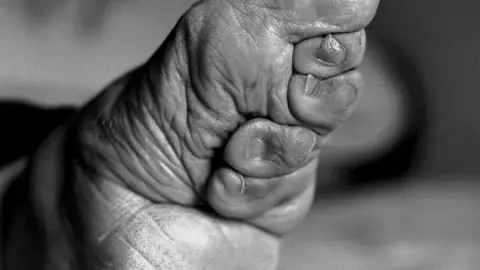 Deformidades en los pies Deformidades en los pies