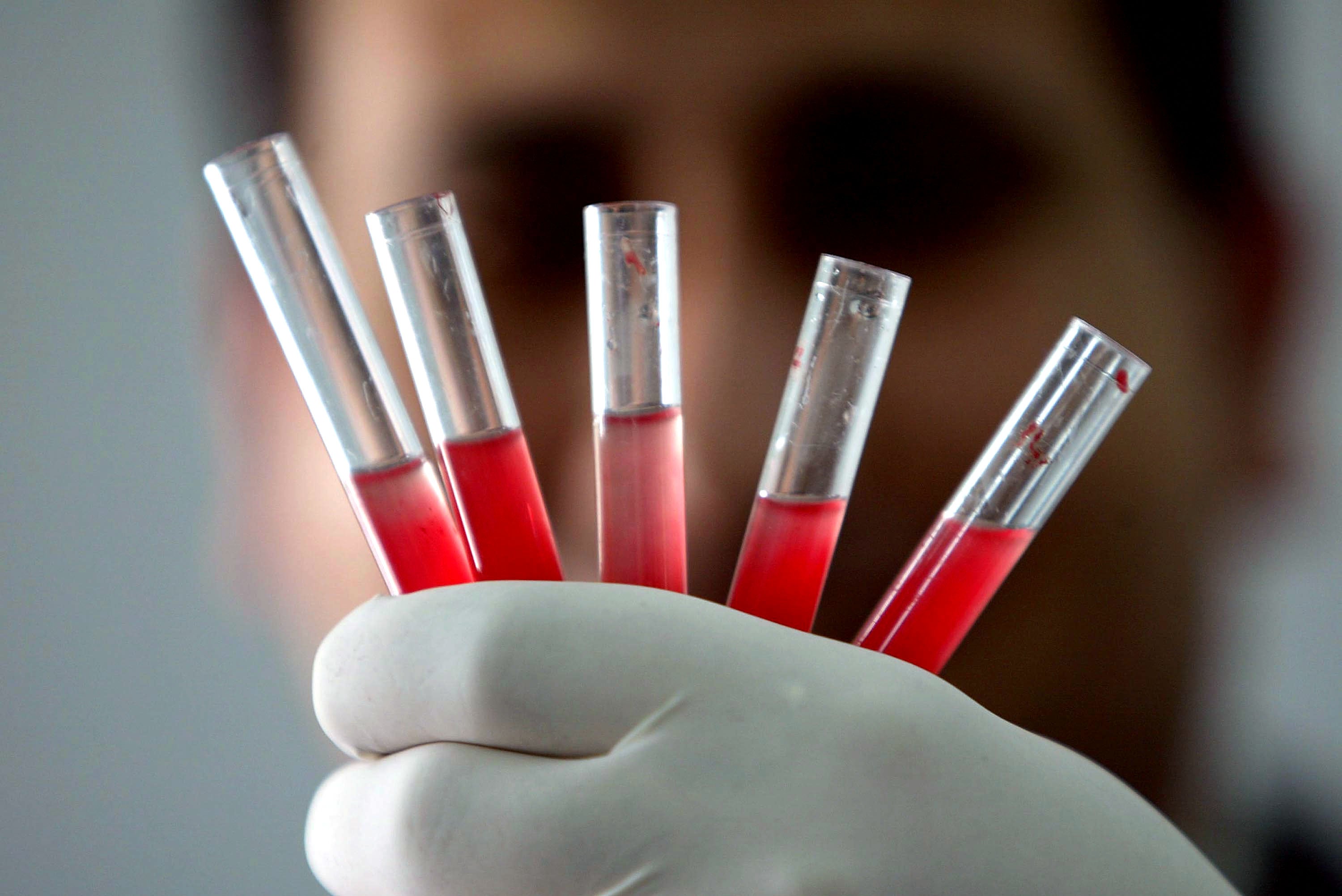 Una terapia génica experimental logra curar la hemofilia tras una única dosis Una terapia génica experimental logra curar la hemofilia tras una única dosis