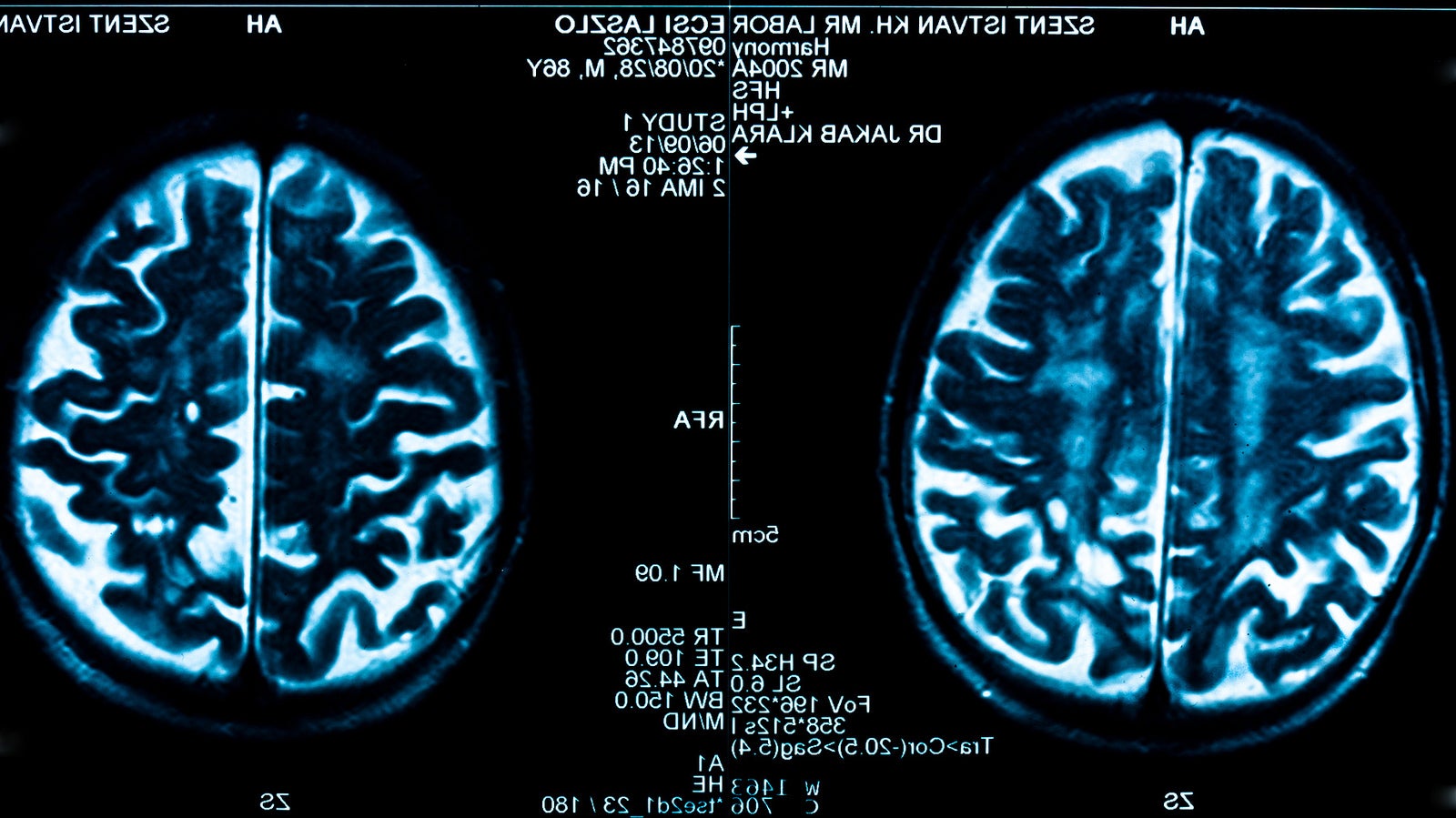El programa de apoyo a familiares de pacientes con daño cerebral llega a Albacete El programa de apoyo a familiares de pacientes con daño cerebral llega a Albacete