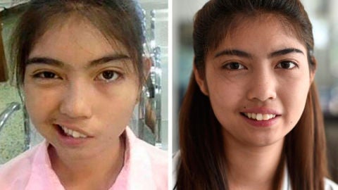 Narudee Jotsanthia, la estudiante tailandesa con la cara paralizada