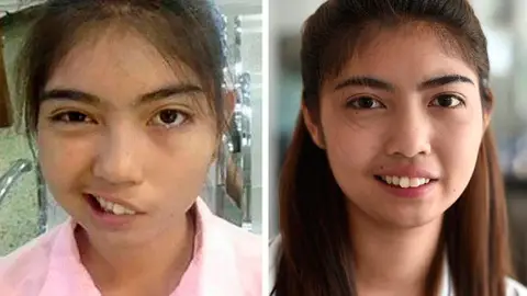 Narudee Jotsanthia, la estudiante tailandesa con la cara paralizada Narudee Jotsanthia, la estudiante tailandesa con la cara paralizada