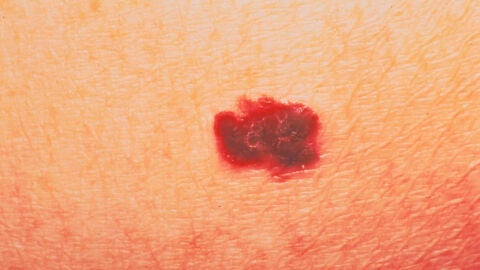 Melanoma