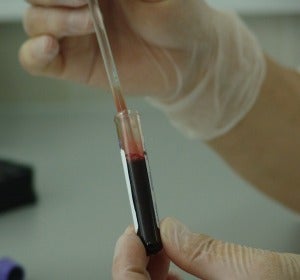 Un análisis de sangre permitiría detectar si tienes cáncer de páncreas y pancreatitis Un análisis de sangre permitiría detectar si tienes cáncer de páncreas y pancreatitis