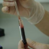 Un análisis de sangre permitiría detectar si tienes cáncer de páncreas y pancreatitis