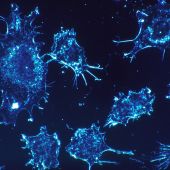 Imagen de archivo de células cancerosas