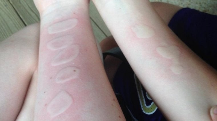 La Guardia Civil alerta sobre el nuevo reto viral: hielo y sal sobre la piel para exhibir las quemaduras La Guardia Civil alerta sobre el nuevo reto viral: hielo y sal sobre la piel para exhibir las quemaduras