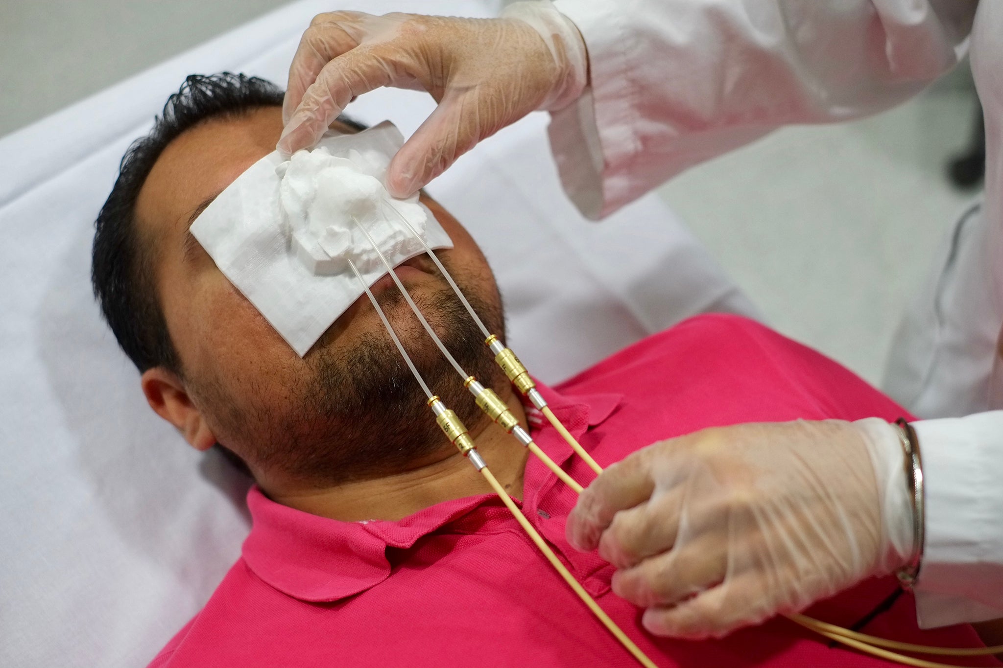 Un hospital español impulsa la impresión 3D en el tratamiento del cáncer de piel Un hospital español impulsa la impresión 3D en el tratamiento del cáncer de piel