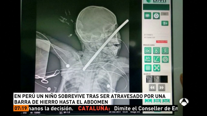 Un niño de cinco años sobrevive tras ser atravesado por una barra de hierro desde el ojo al abdomen Un niño de cinco años sobrevive tras ser atravesado por una barra de hierro desde el ojo al abdomen