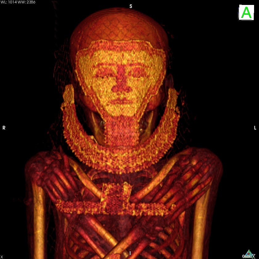 Antropólogos de la UGR descubren junto a investigadores internacionales el caso de cáncer de mama más antiguo de la historia Antropólogos de la UGR descubren junto a investigadores internacionales el caso de cáncer de mama más antiguo de la historia