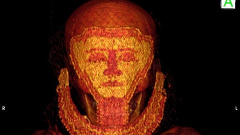 Antrop&oacute;los de la UGR descubren el caso m&aacute;s antiguo de cancer de mama