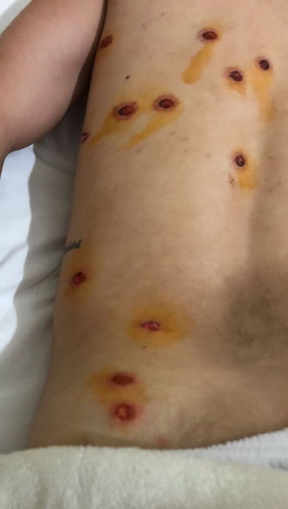 Heridas de Julián Gauna tras la los disparos de la policía