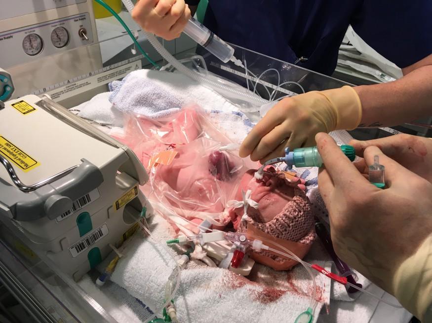 Nace en Reino Unido un bebé con el corazón fuera del pecho Nace en Reino Unido un bebé con el corazón fuera del pecho