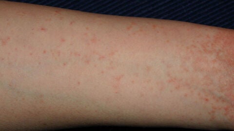 Brazo con dermatitis