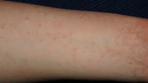 Brazo con dermatitis Brazo con dermatitis