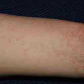 Brazo con dermatitis Brazo con dermatitis