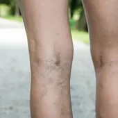 Varices en las piernas Varices en las piernas