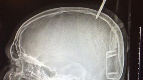 Radiograf&iacute;a que muestra la perforaci&oacute;n del cr&aacute;neo