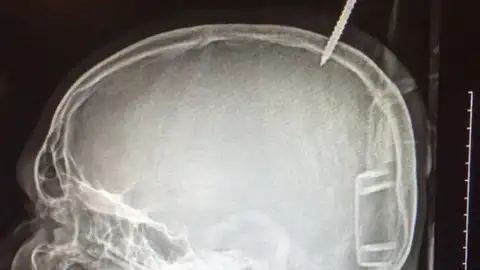 Radiografía que muestra la perforación del cráneo Radiografía que muestra la perforación del cráneo