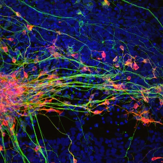 Un análisis de sangre te dice si tendrás parkinson... siete años antes Un análisis de sangre te dice si tendrás parkinson... siete años antes