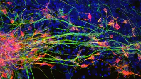 La proteina RAC1 nueva diana contra la degeneracion neuronal en parkinson La proteina RAC1 nueva diana contra la degeneracion neuronal en parkinson