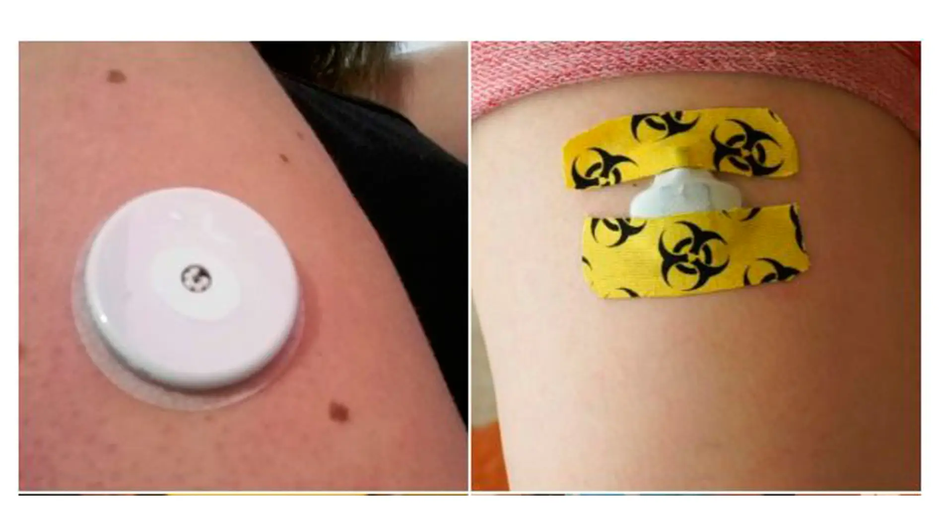 Sensores para enfermos de diabetes