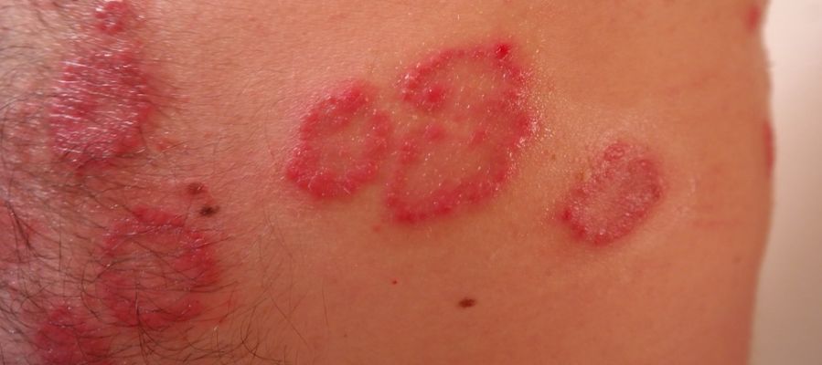Caso de Psoriasis Caso de Psoriasis