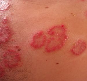 Caso de Psoriasis Caso de Psoriasis