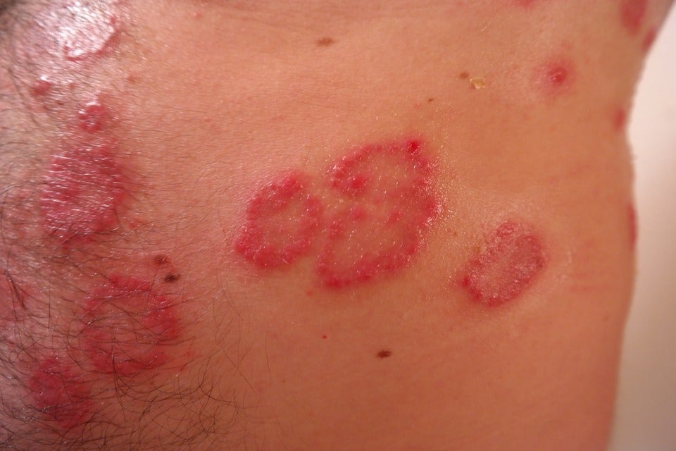 Más de 30.000 aragoneses padecen psoriasis. Más de 30.000 aragoneses padecen psoriasis.