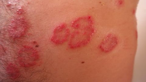Caso de Psoriasis