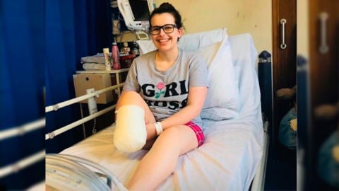 Victoria Snell, la joven que decidi&oacute; amputarse la pierna