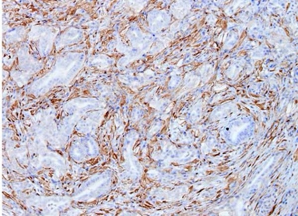 Un estudio del Hospital del Mar halla una pieza clave para tratar cáncer de páncreas Un estudio del Hospital del Mar halla una pieza clave para tratar cáncer de páncreas