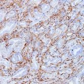 Células tumorales de cáncer de páncreas del modelo Kras del CNIO