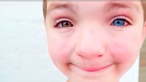 Madden, el ni&ntilde;o de 7 a&ntilde;os con labio leporino y un ojo de cada color