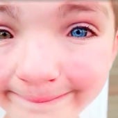 Madden, el niño de 7 años con labio leporino y un ojo de cada color