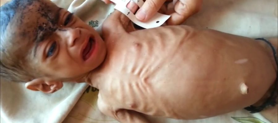 Incremento de la desnutrición infantil en Yemen Incremento de la desnutrición infantil en Yemen