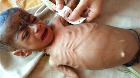 Incremento de la desnutrici&oacute;n infantil en Yemen