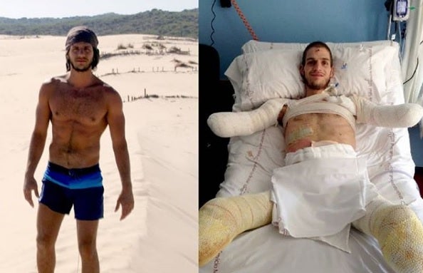 Una bacteria provoca a un joven la amputación de sus extremidades y pide ayuda para unas prótesis Una bacteria provoca a un joven la amputación de sus extremidades y pide ayuda para unas prótesis