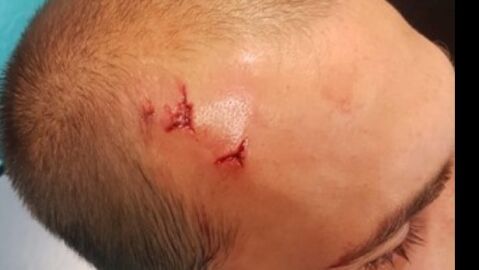 Bas Dost, jugador del Sporting, con una herida en la cabeza