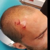 Bas Dost, jugador del Sporting, con una herida en la cabeza