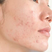 Tratamientos caseros para pieles con acné
