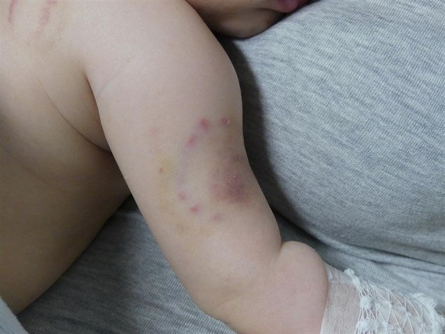 Detienen a los padres de un bebé, que presenta lesiones compatibles con mordeduras Detienen a los padres de un bebé, que presenta lesiones compatibles con mordeduras